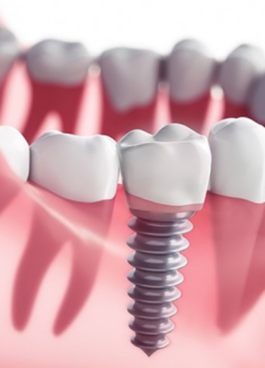 Picture of Dental Implants