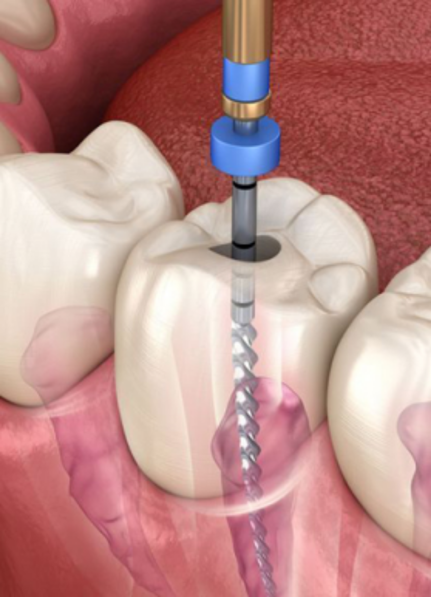 Picture of Root Canal Therapy