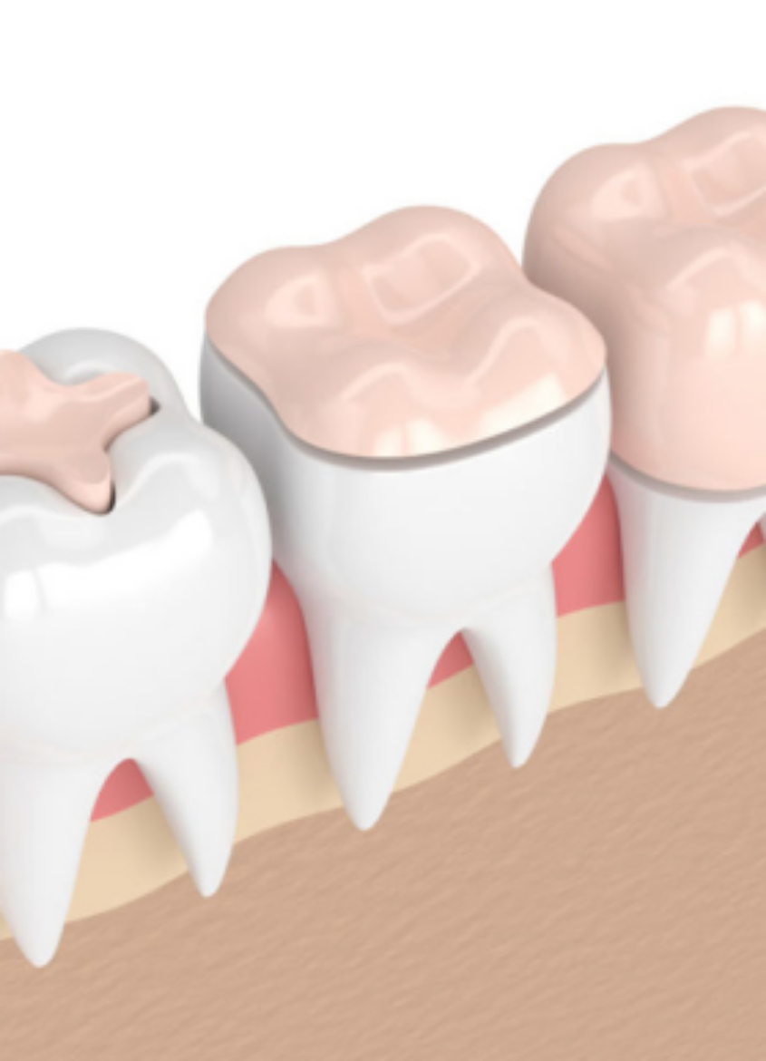 Picture of Dental Veneers