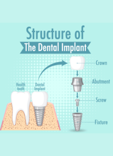 Picture of Dental Implants