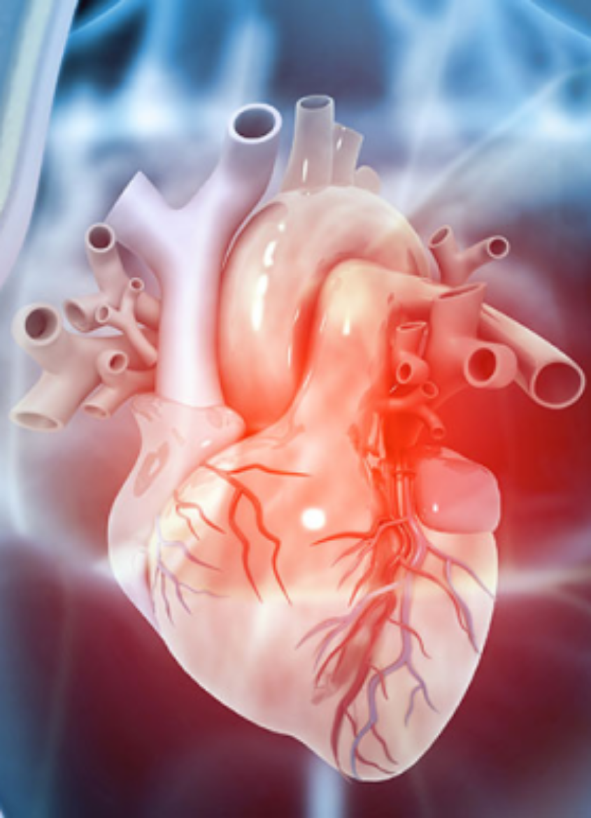 Picture of Coronary Angioplasty